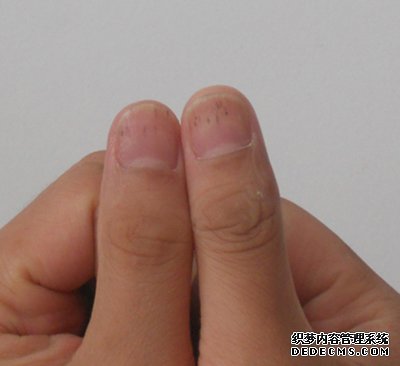指甲上有白點是怎么回事？